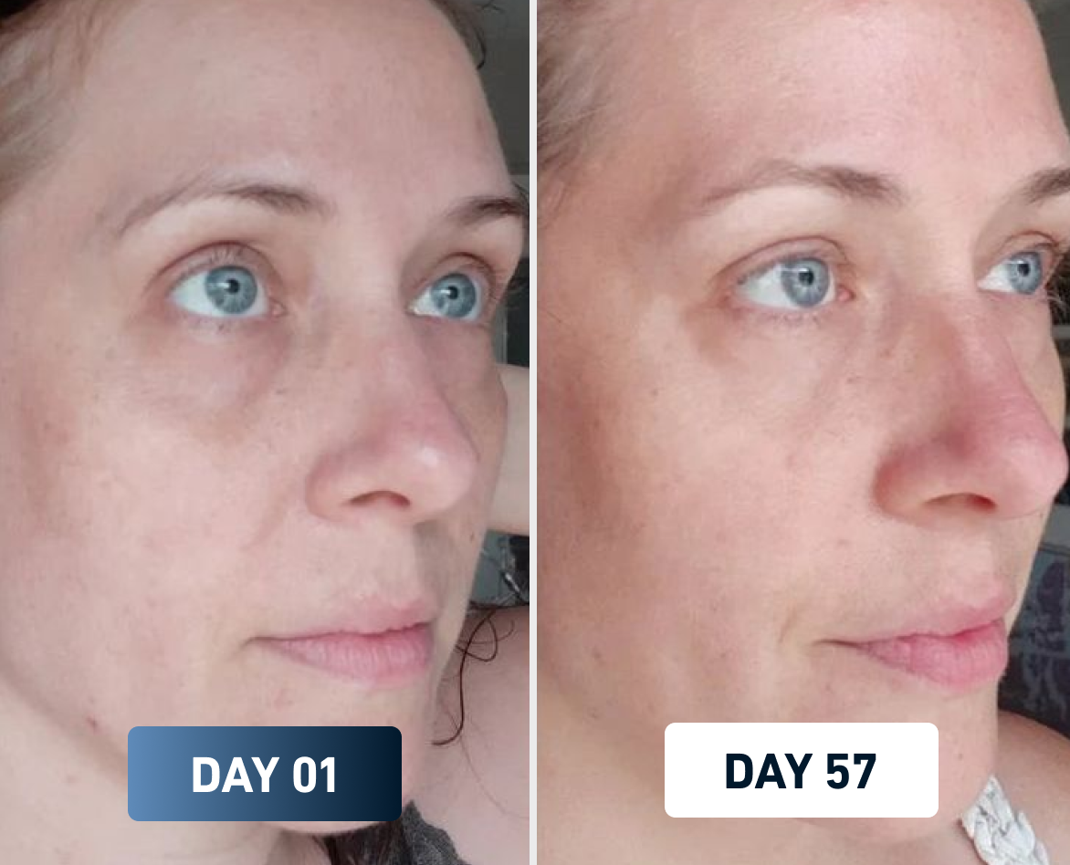 Day 1 vs Day 43 clearer skin results from using FlowMist water filtration shower head