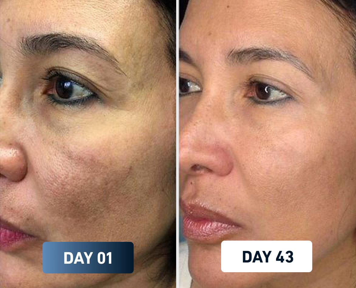 Before and after skin improvement using FlowMist filtered high-pressure shower head – 43-year-old woman