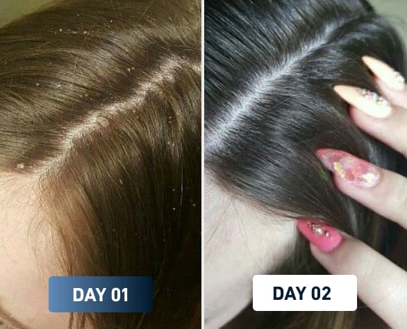 Before and after scalp flakes improvement using FlowMist filtered shower head – Day 1 to Day 2