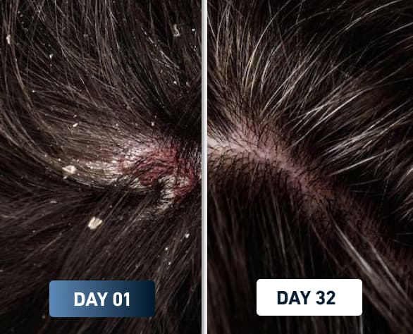 Dry scalp reduction after switching to FlowMist high-pressure filtered shower head