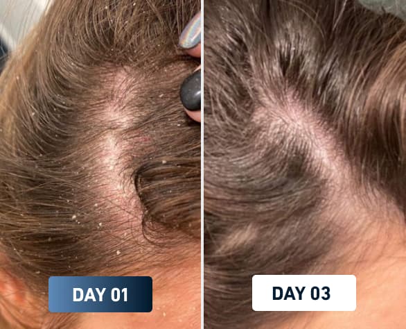 Scalp flakes disappearing after 1 day of cleaner filtered shower water – FlowMist results